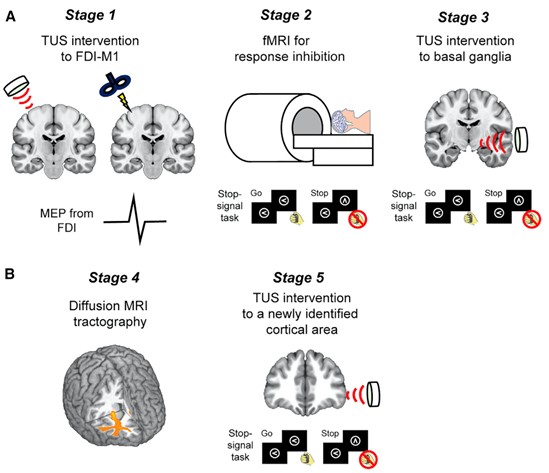 Experimental setup to suppress brain activity and explore the basal ganglia regions involved in the response inhibition response